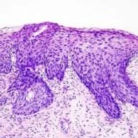 Чем опасна дисплазия шейки матки?