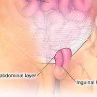 Чем опасна паховая грыжа