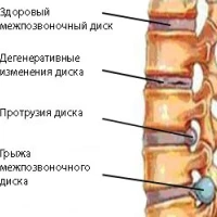 Чем опасны боли в шее?