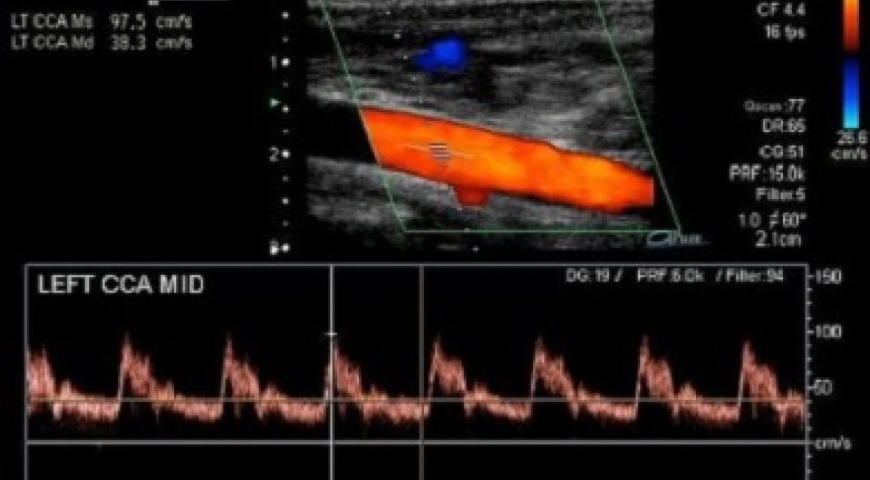 Що таке доплер судин?