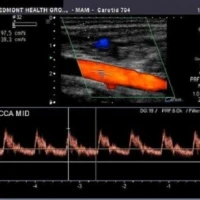 Що таке доплер судин?