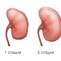 Что такое гидронефроз и как его лечить