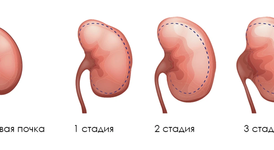 Що таке гідронефроз та як його лікувати?