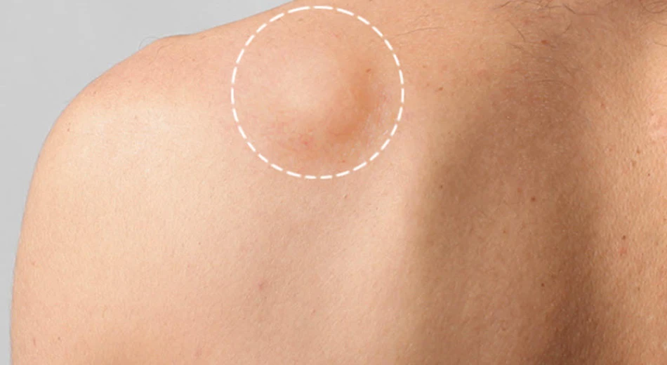 Что такое липома, чем она опасна и как лечится?