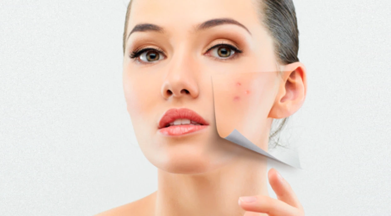 Демодекоз: симптоми, причини та методи лікування