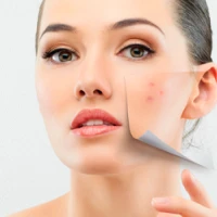 Демодекоз: симптомы, причины и методы лечения