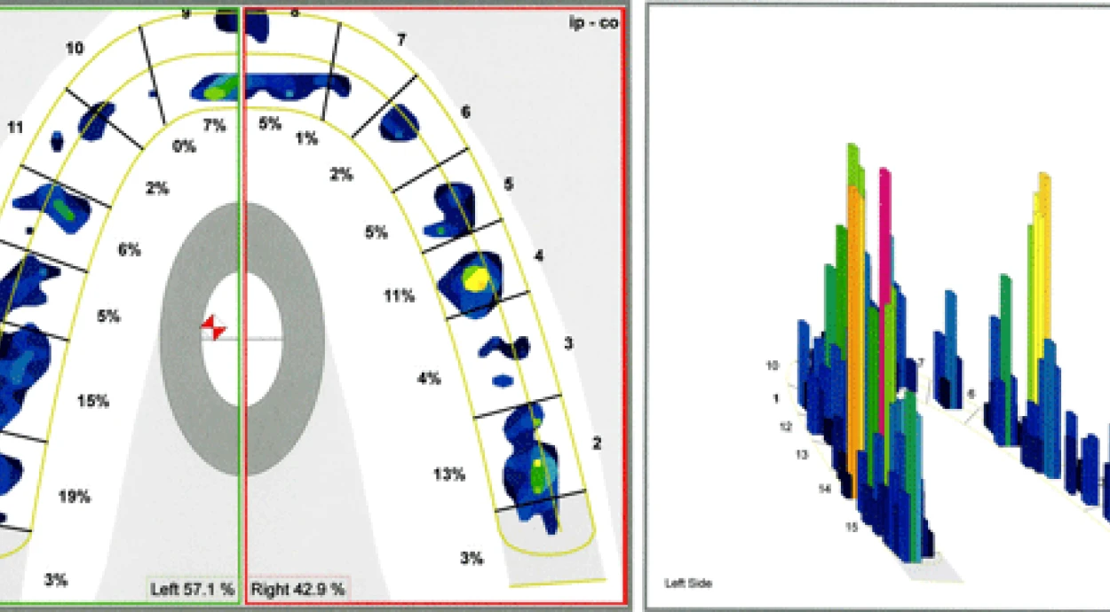 Диагностика окклюзии с аппаратом T-Scan III