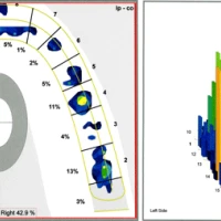 Диагностика окклюзии с аппаратом T-Scan III
