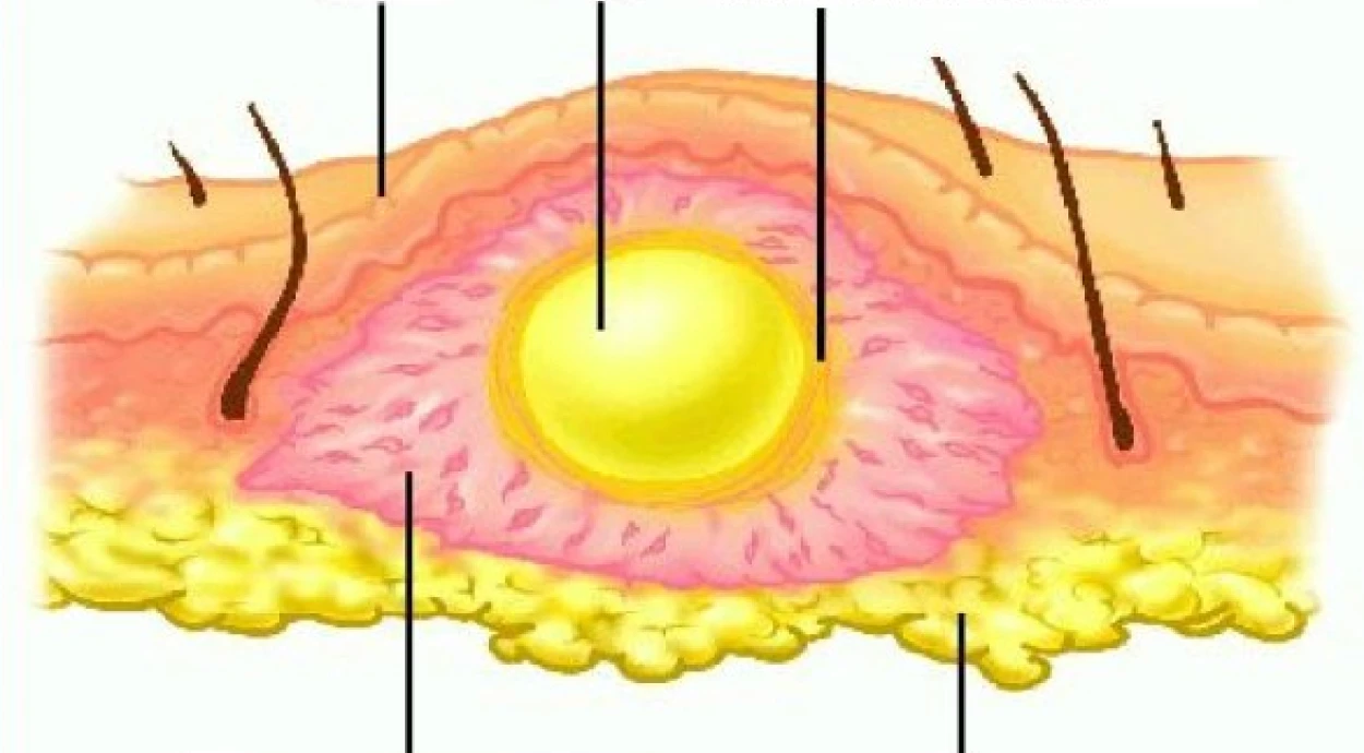 Флегмона: что это и как лечится?