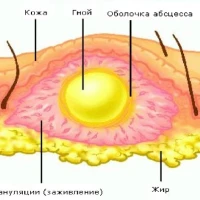 Флегмона: что это и как лечится?