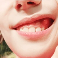 Флюс на десне: причины, симптомы и методы лечения