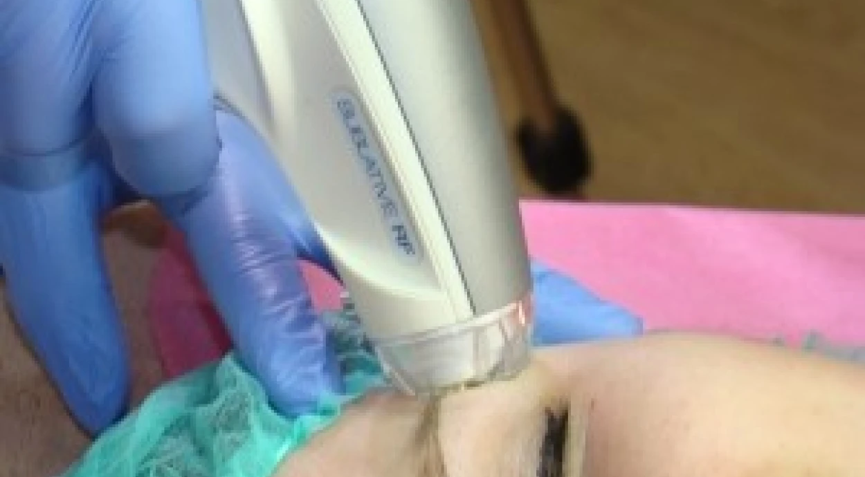 Фракционное омоложение E-matrix - альтернатива лазерной шлифовке: результат превосходит все ожидания