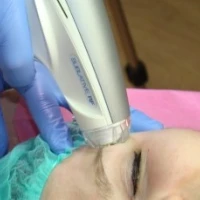 Фракционное омоложение E-matrix - альтернатива лазерной шлифовке: результат превосходит все ожидания