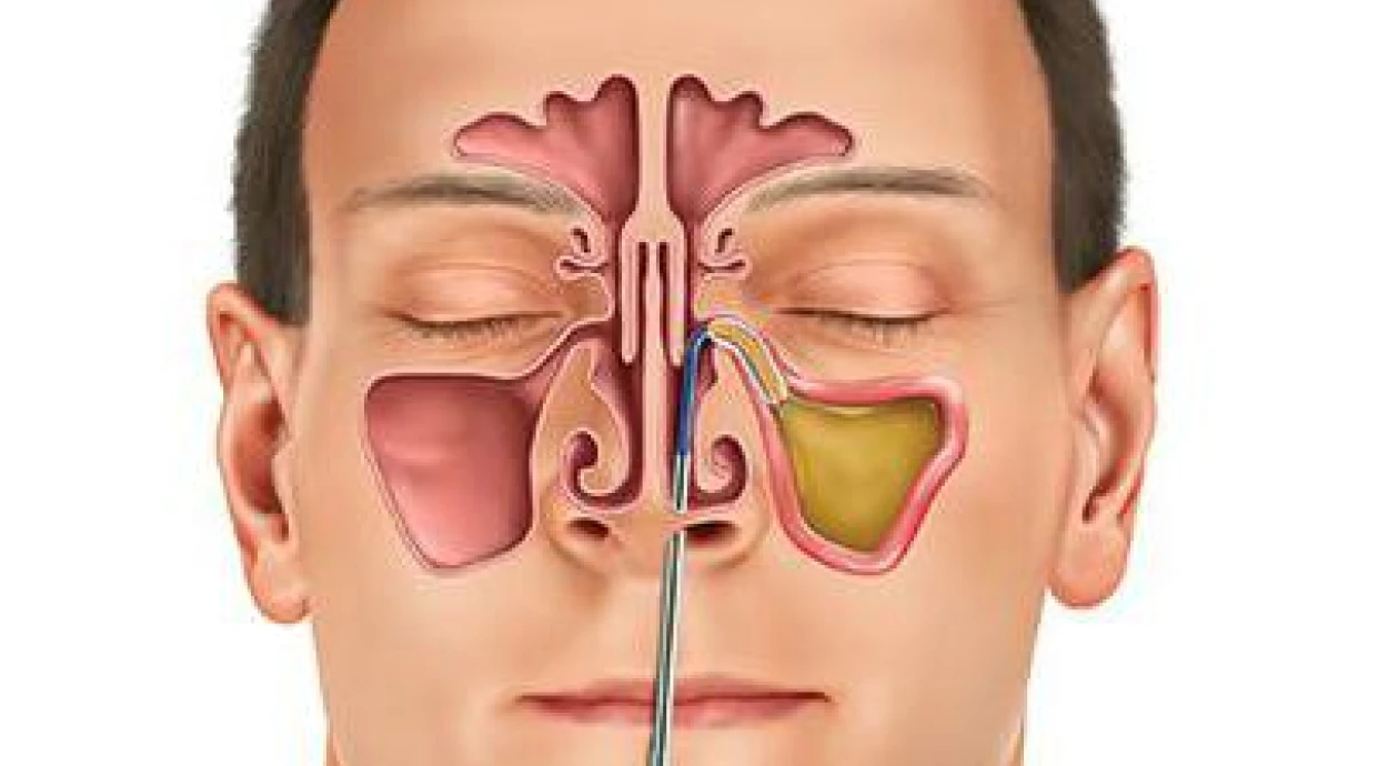 Maxillary sinusotomy (opening of the maxillary sinus)