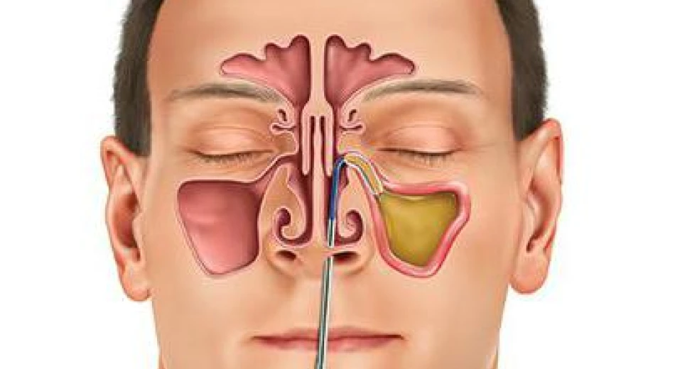 Maxillary sinusotomy (opening of the maxillary sinus)