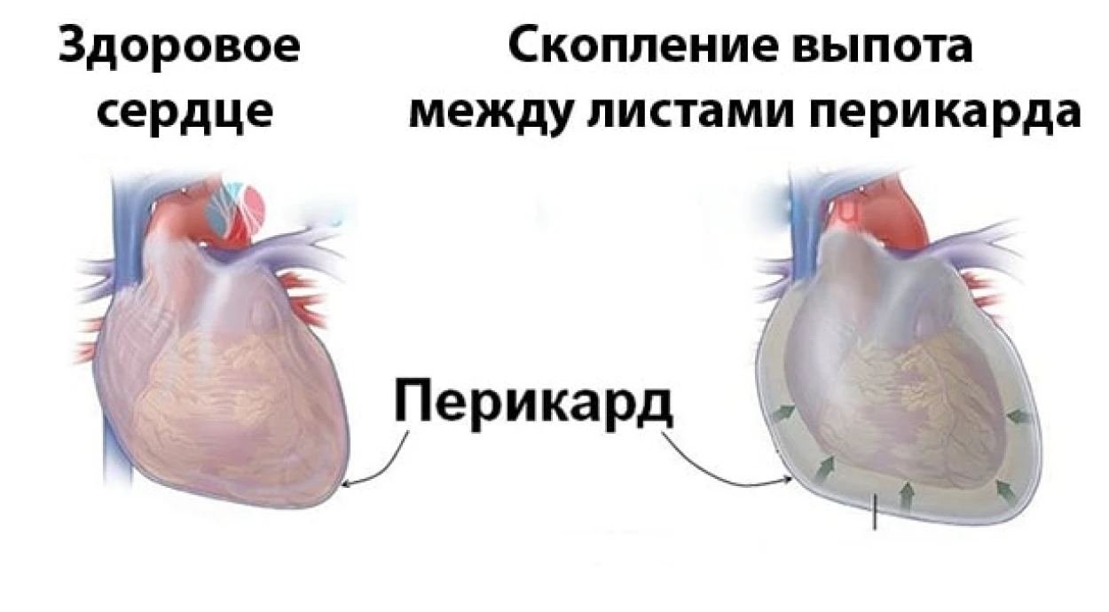 Гидроперикард: симптомы, причины и методы лечения