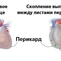 Гидроперикард: симптомы, причины и методы лечения