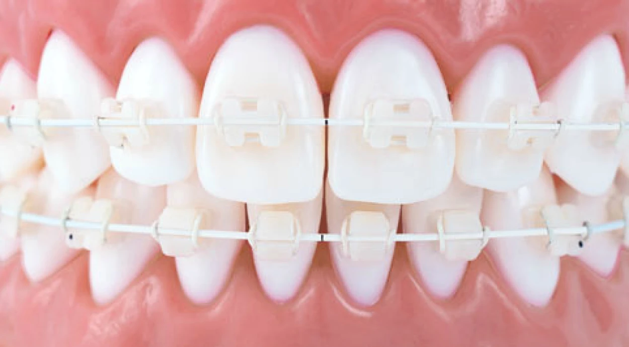 Инвизилайн – современная альтернатива брекетам!