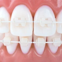 Инвизилайн – современная альтернатива брекетам!