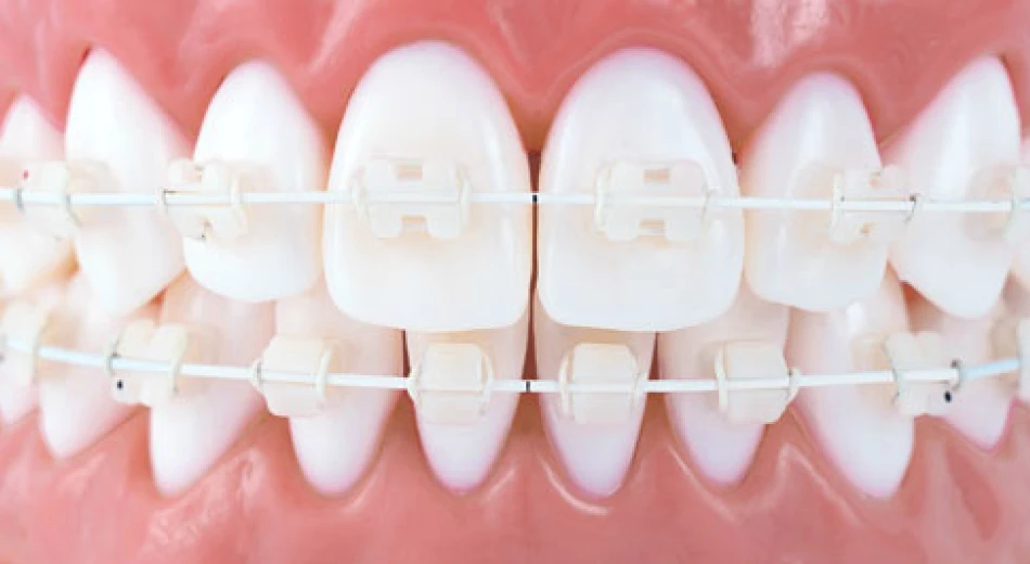 Інвізілайн – сучасна альтернатива брекетів!