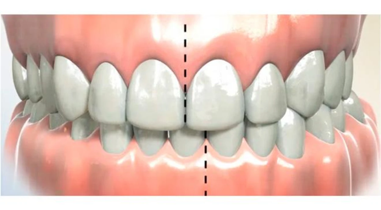 Исправление прикуса