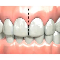 Исправление прикуса