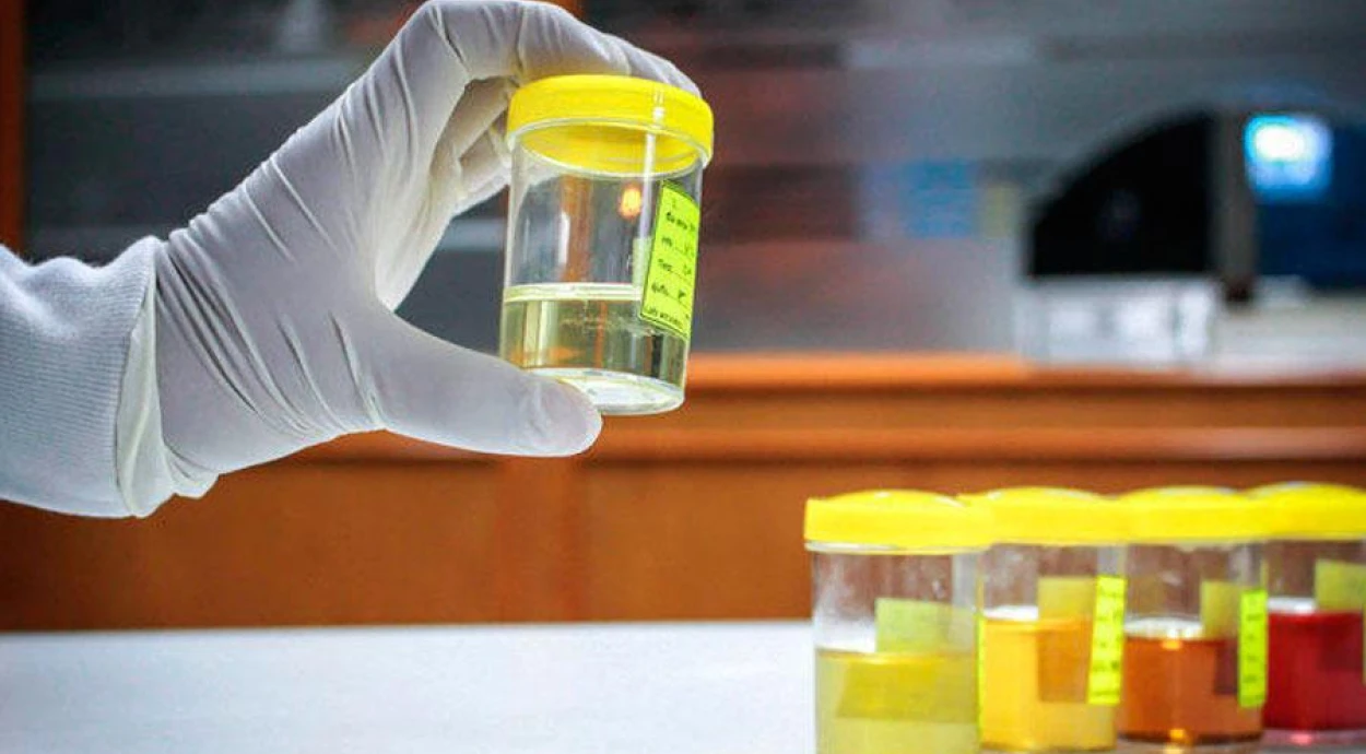 Изменение цвета мочи: возможные причины