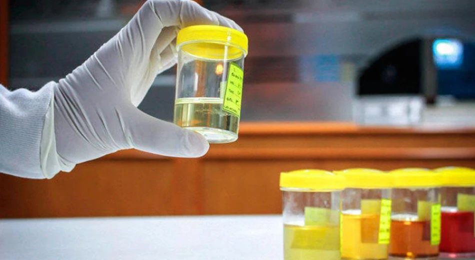 Зміна кольору сечі: можливі причини