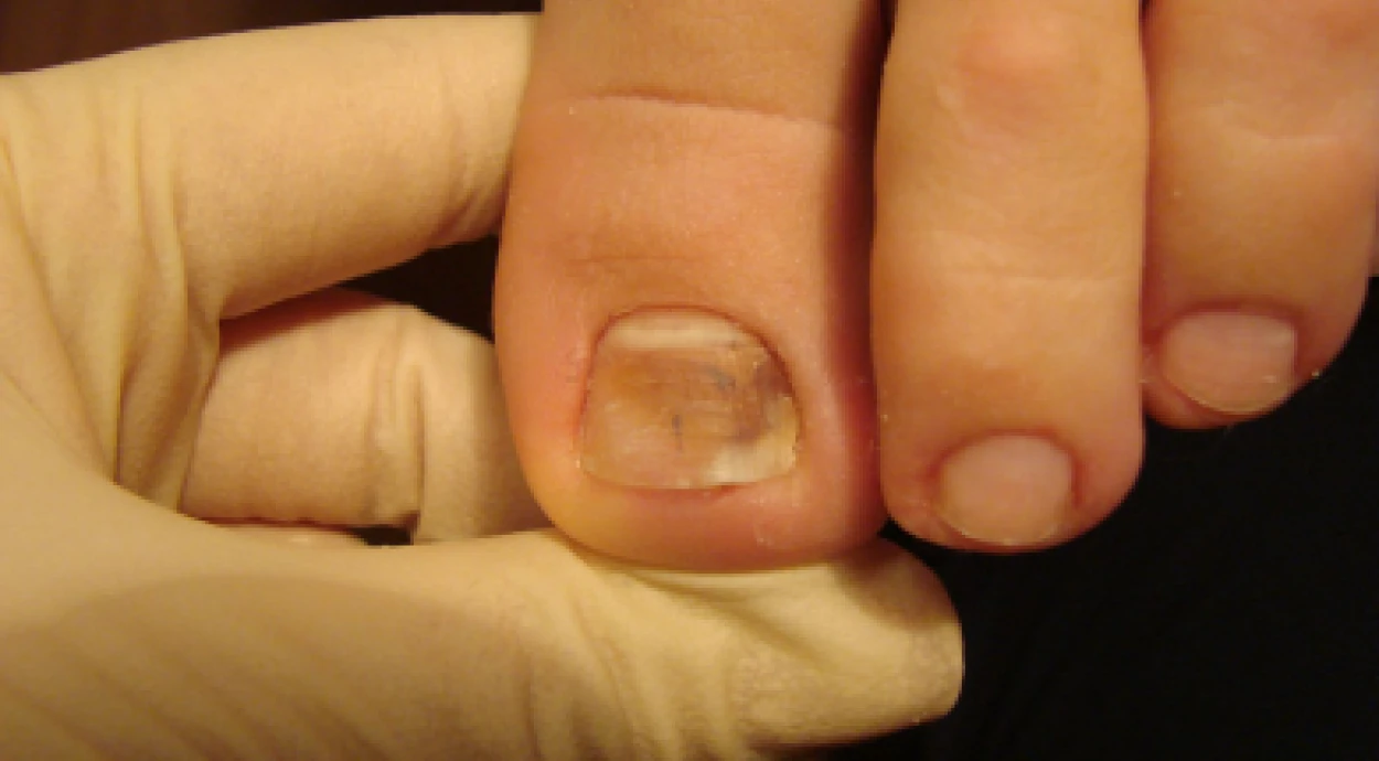 Как и чем лечить грибок на ногах у ребенка