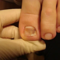 Как и чем лечить грибок на ногах у ребенка