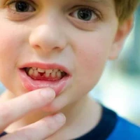 Як лікувати гінгівіт у дітей?