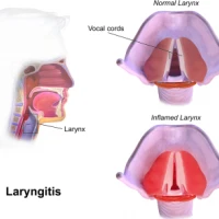 Як правильно лікувати ларингіт?