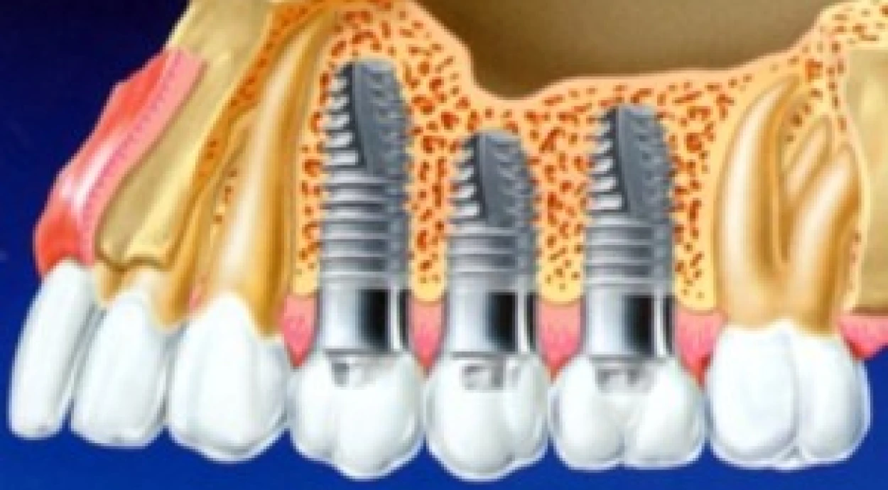 Как выбирать зубные импланты?