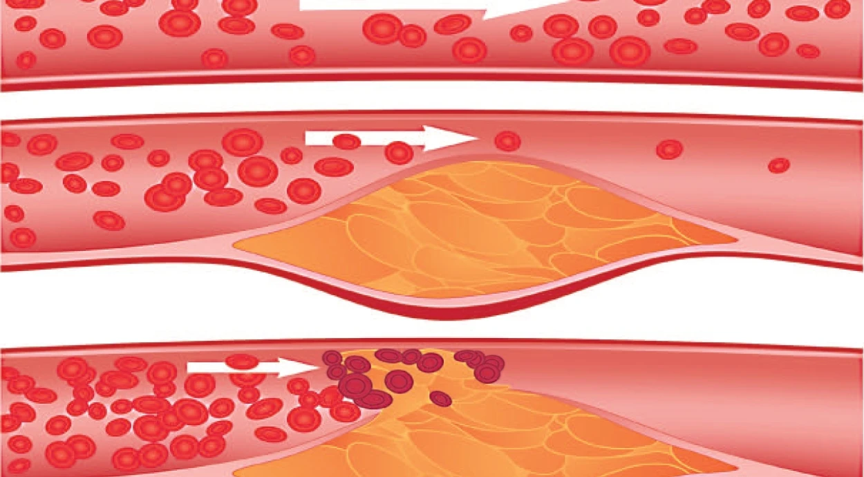 Как вылечить атеросклероз сосудов ног?