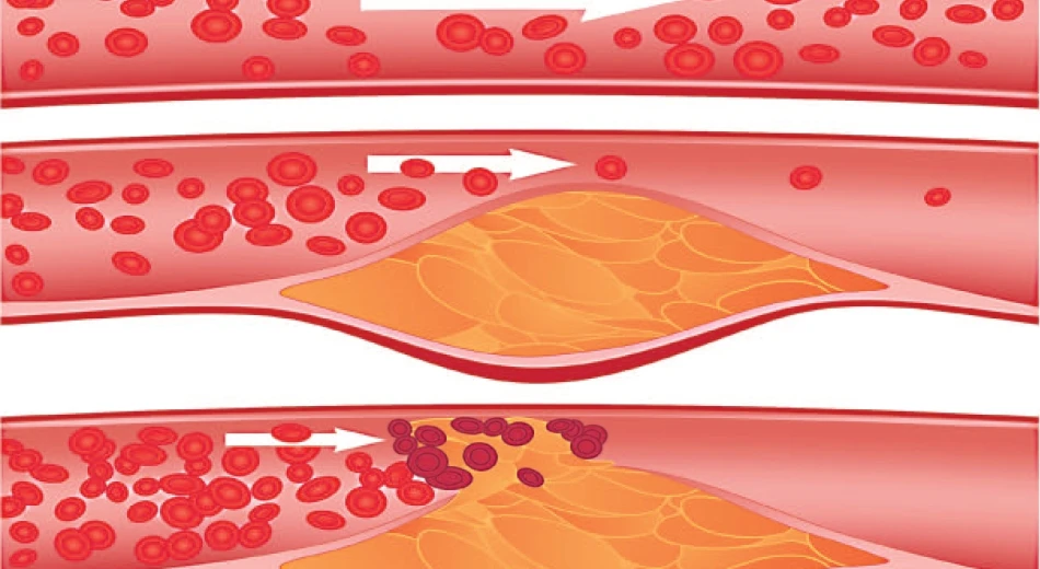 Как вылечить атеросклероз сосудов ног?