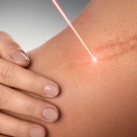 Какие типы шрамов и рубцов можно лечить с помощью лазерной шлифовки?