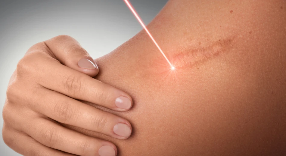 Какие типы шрамов и рубцов можно лечить с помощью лазерной шлифовки?