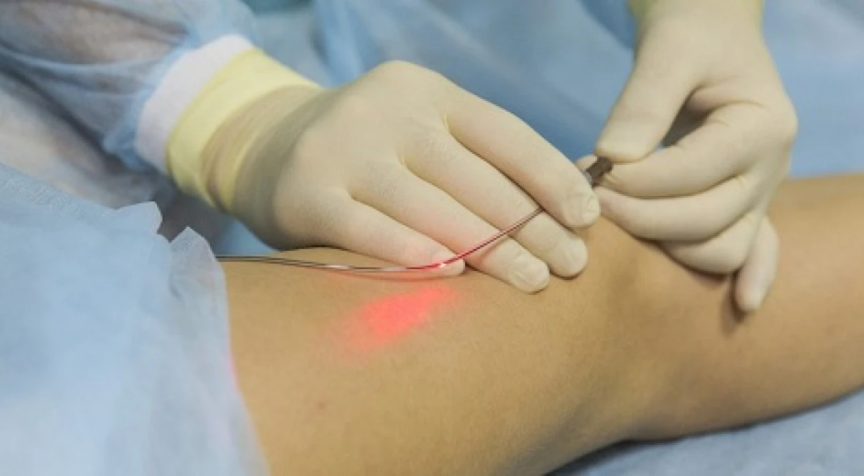 Какой метод лечения при варикозе лучше: склеротерапия, лазерная коагуляция или операция?