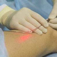 Какой метод лечения при варикозе лучше: склеротерапия, лазерная коагуляция или операция?