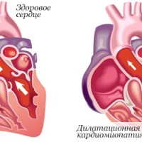 Кардиомиопатии: симптомы, виды заболеваний и методы лечения