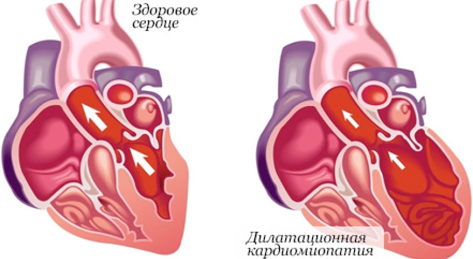 Кардиомиопатии: симптомы, виды заболеваний и методы лечения