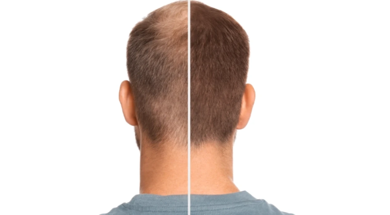 Кому нужна пересадка волос: специалист рассказал, как она проводится и какой метод наиболее эффективен