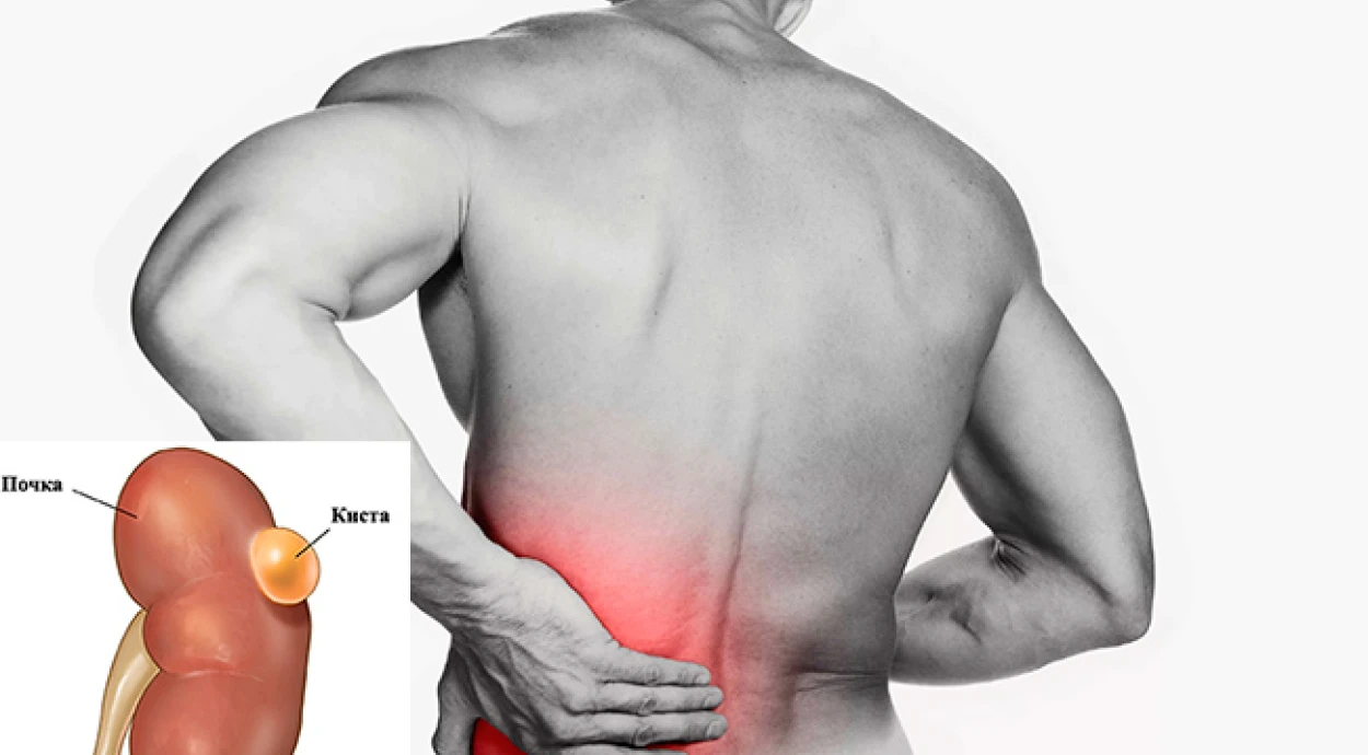 Лапароскопическое удаление кисты почки