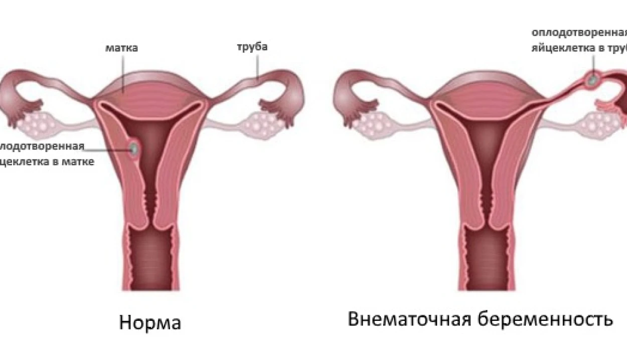 Лапароскопическое вмешательство при внематочной беременности