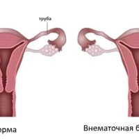 Лапароскопическое вмешательство при внематочной беременности