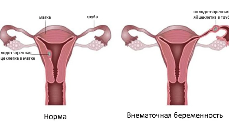 Лапароскопическое вмешательство при внематочной беременности