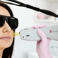 Лазерная шлифовка лица