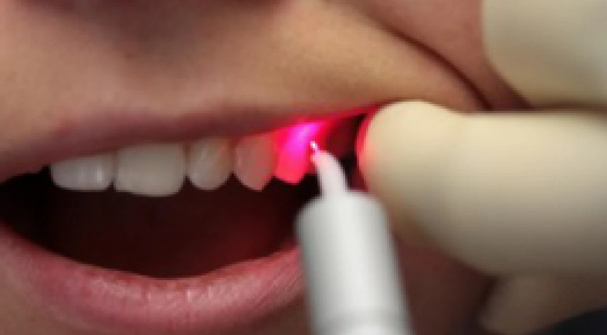 Лазерное лечение зубов