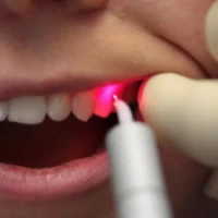 Лазерное лечение зубов