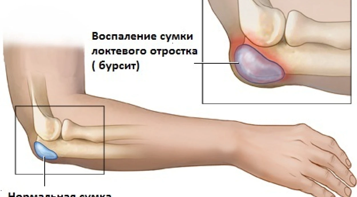 Лечение брусита